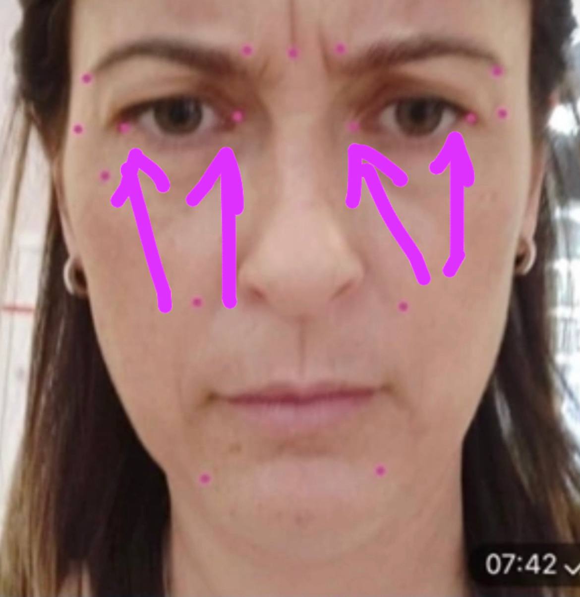 Маида, я имела ввиду точки внешнего и внутреннего угла глаза. Процерус/корругатор я не комментировала...