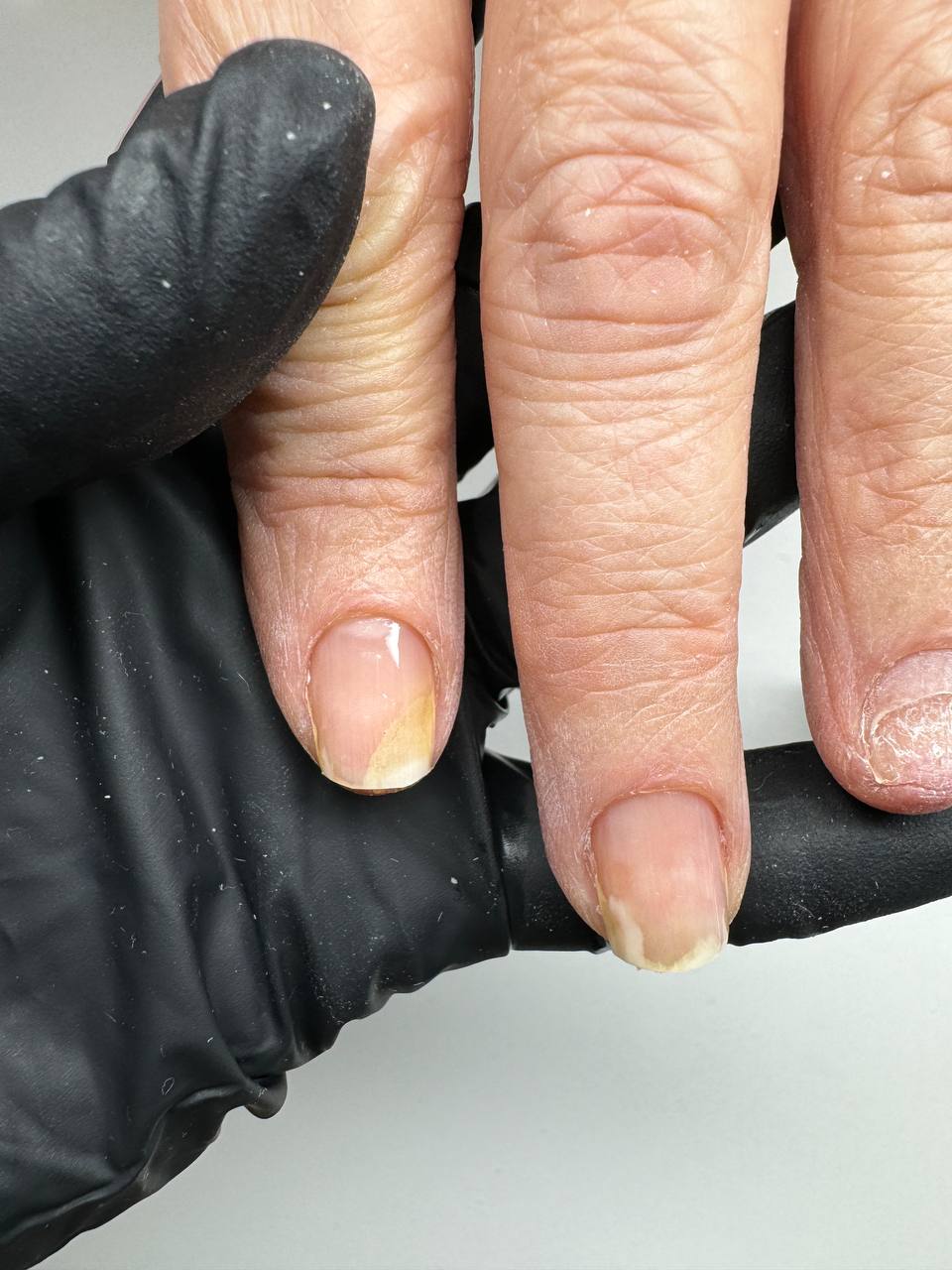 Здравствуйте, дорогие коллеги. Помогите определиться с тактикой:
Женщина около 50 лет, с детства имеет...