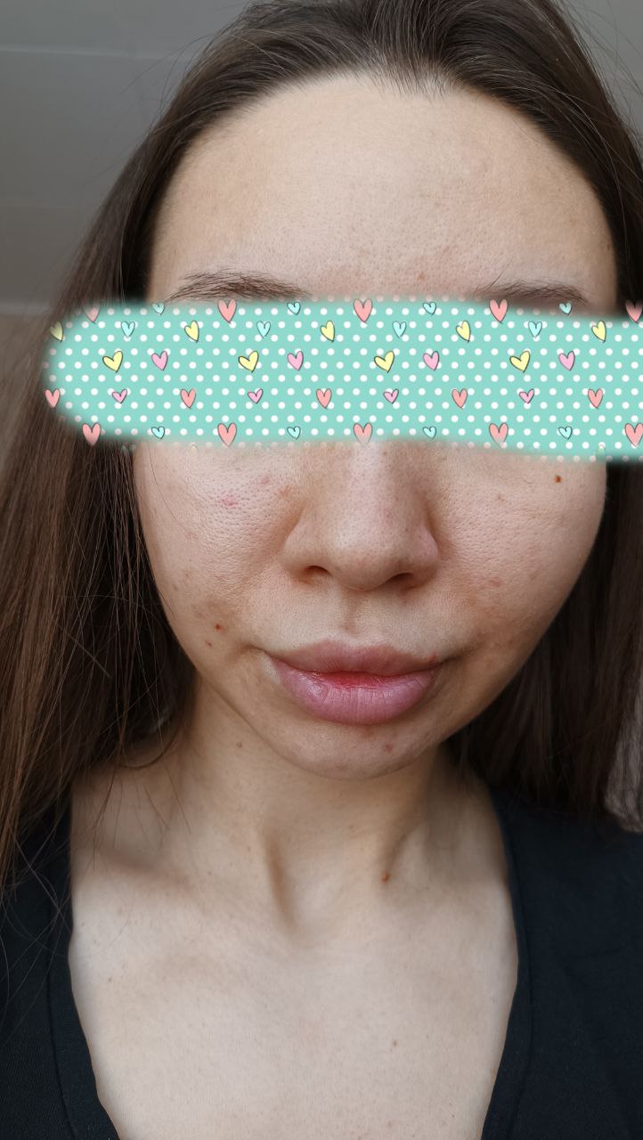 Здравствуйте милые косметологи! 
Мне 23 , проблемы с кожей с 12 лет (с переходного возраста).Веду здоровый...