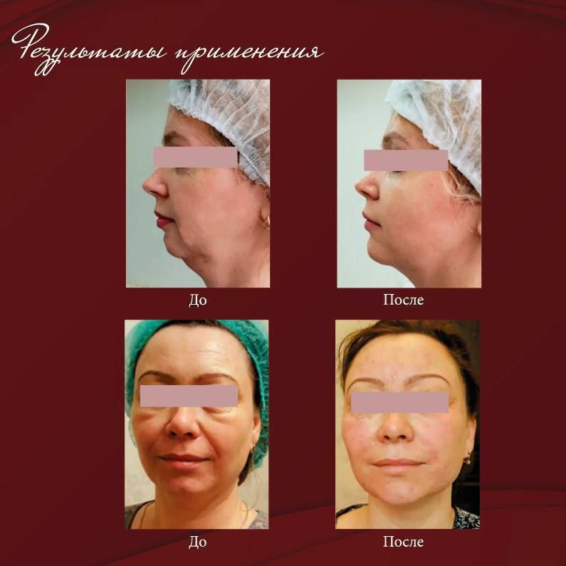   Suprem Myo (Супрем Мио) 

 Состав  : 
⁃ ГК 2.2%
⁃ ПДРН 1%
⁃ Аргирелин 0.02%
⁃ Сукцинат натрия 0.5%
 
...