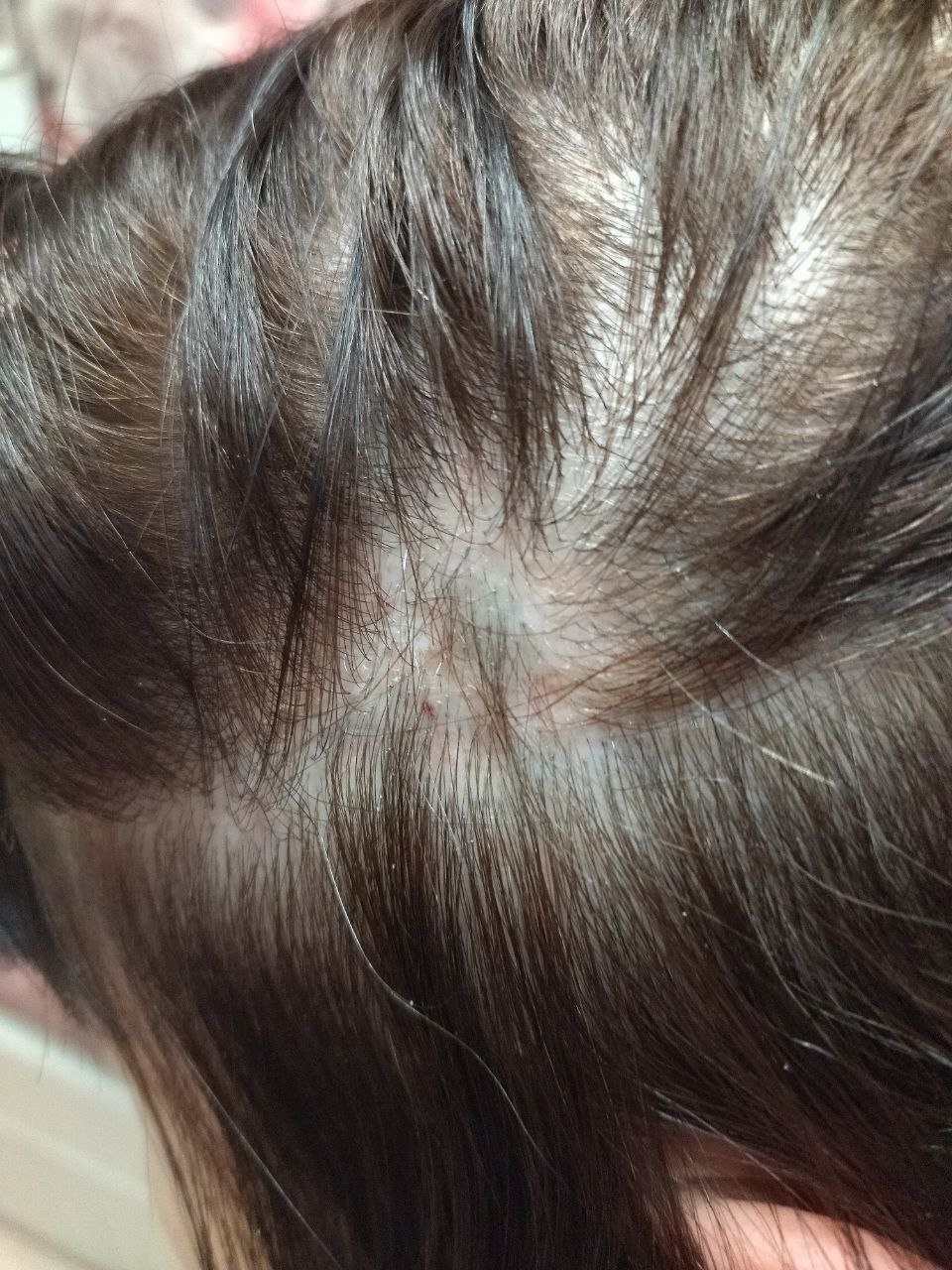 Сейчас попробую сфоткать,но они уже хорошо заросли очагов было около 5 точно...