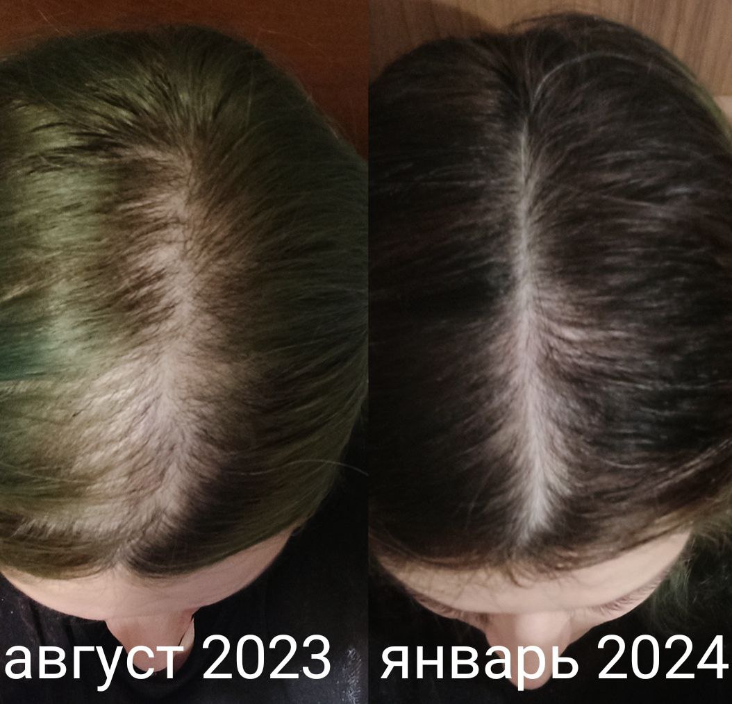 Всем здравствуйте! Поделюсь своей историей для статистики. В августе 23 года была у трихолога, поставили...