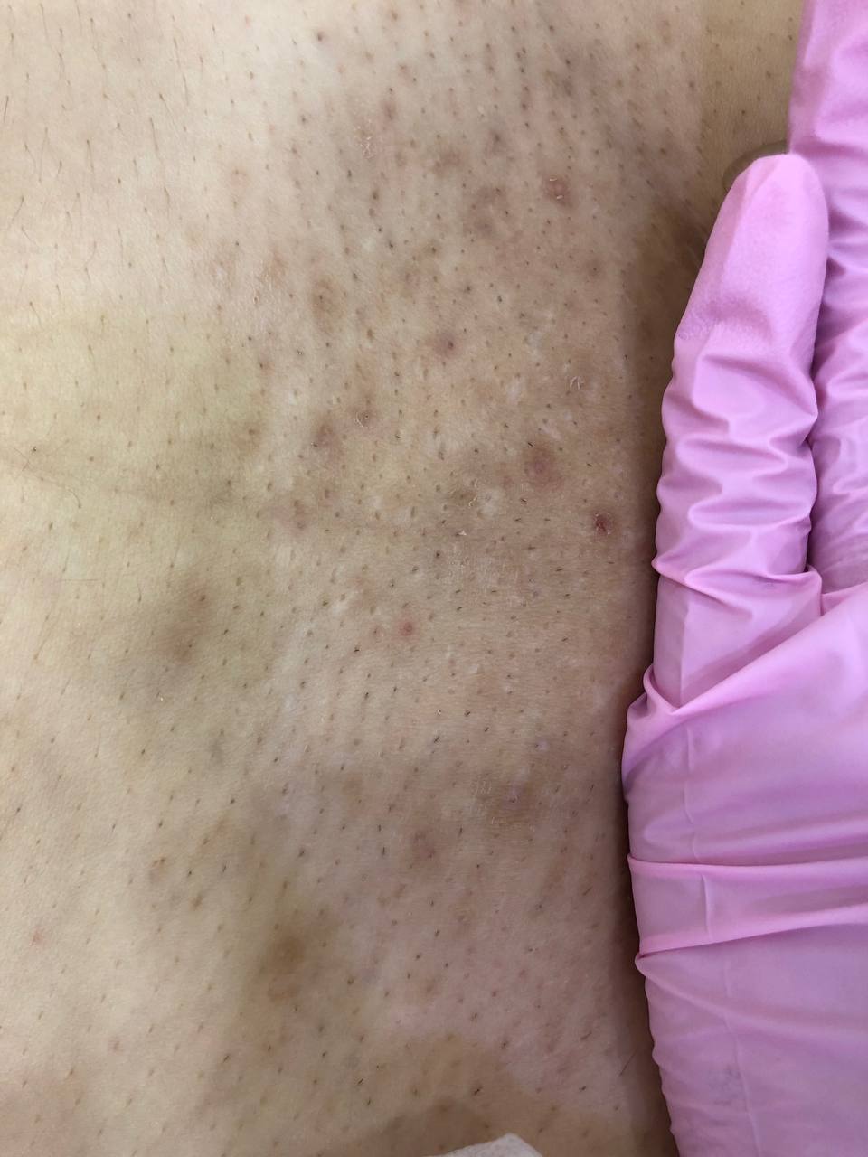 Добрый день , пациенты или клиенты пришедшие после лазера к примеру Candela привыкли к такому результату...
