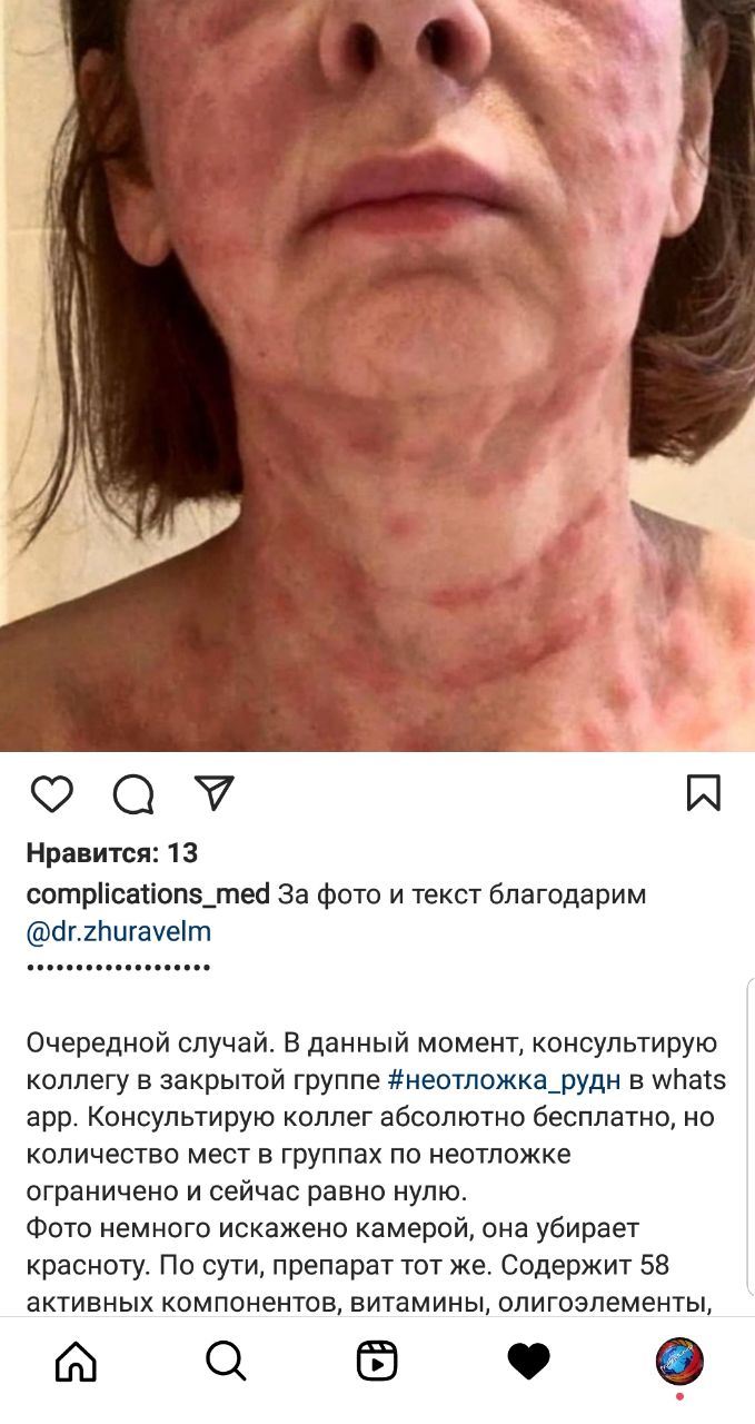 Хорошие отзывы только от продавцов дермахила. У пациентов папулы,  которые не проходят месяцами...