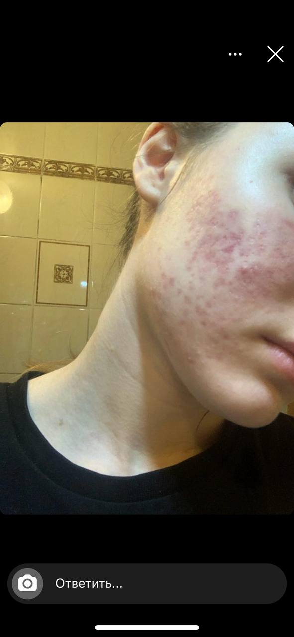 Здравствуйте, можно ли это убрать курсом миндального пилинга...