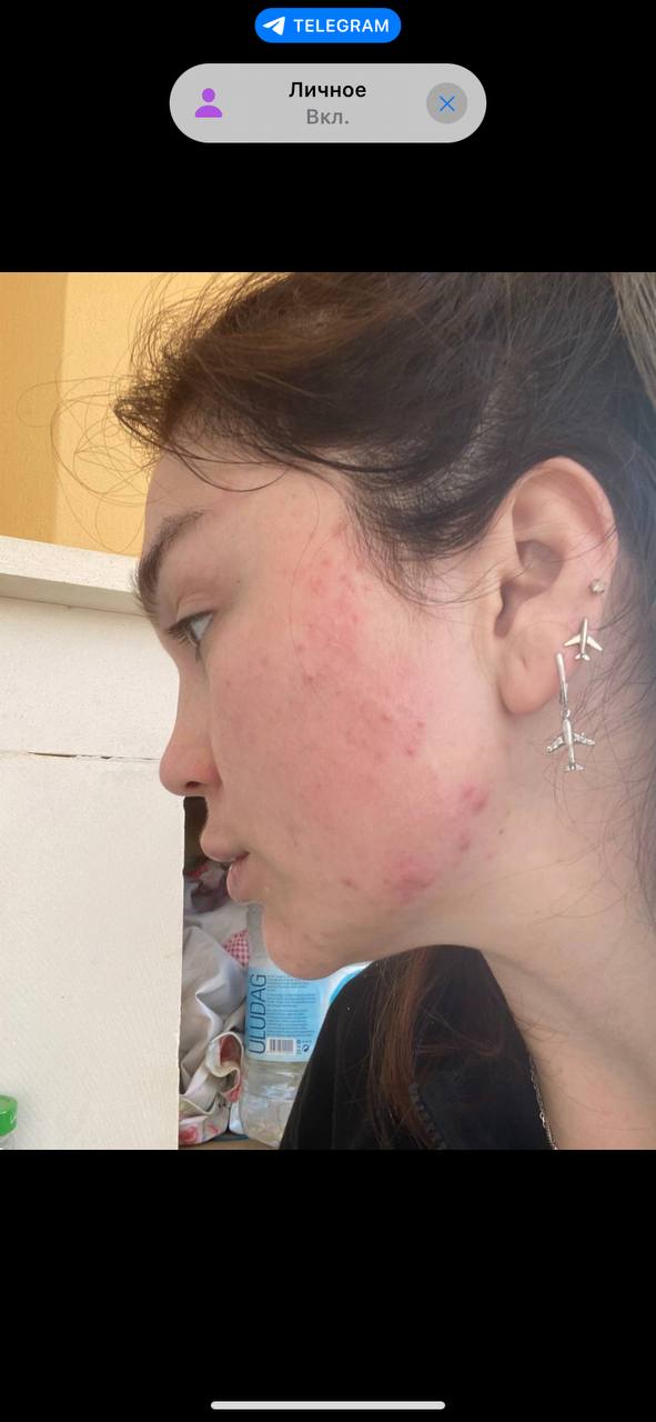 Здравствуйте, обратилась пациентка , говорит делала чистку в Москве после чистки появилось такое и не...