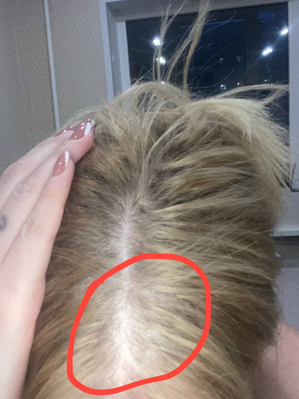 Здравствуйте    Подскажите пожалуйста,это алопеция ??Там есть 2 лысых пятна где не растут волосы .вообще...