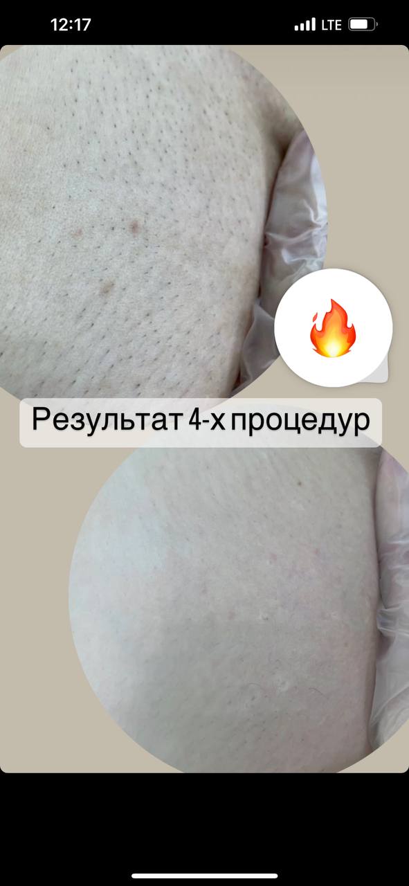 У нас после второго визита мы смотрим как уходит волос и начинаем увеличивать промежутки и большинства...