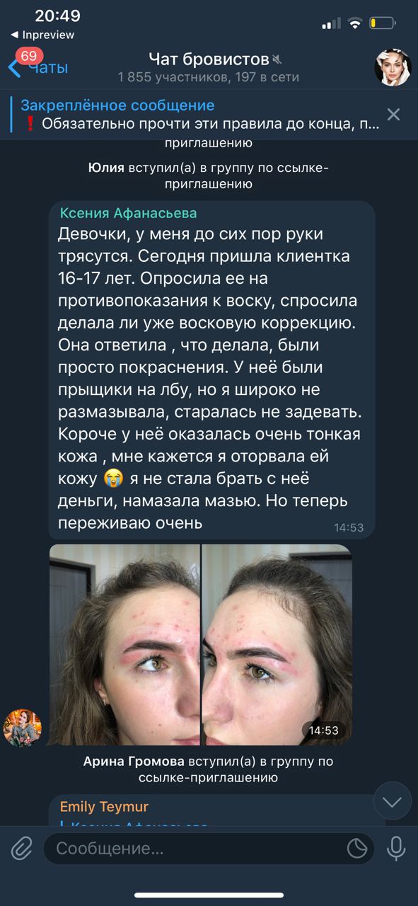 Вот.. но это даже больше на какой-то ожог/аллергию чтоли похоже. Я просто недавно перешла на gigi с пленочного...