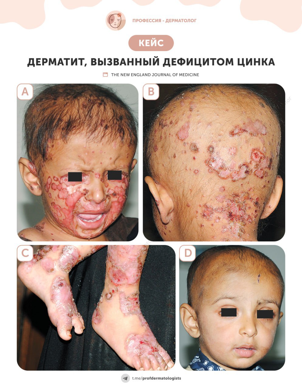 Вот дефицит цинка, кстати. А мы его многие просто так пьем...