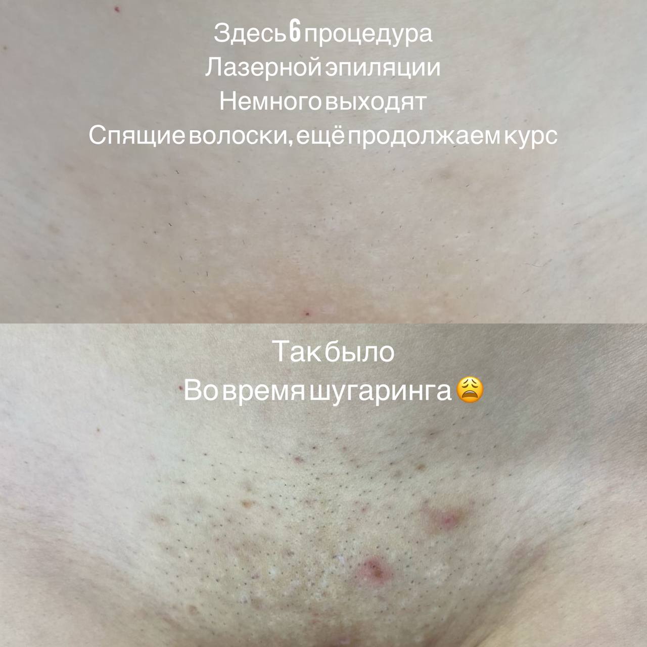 У клиента до лазера были очаги витилиго ?...
