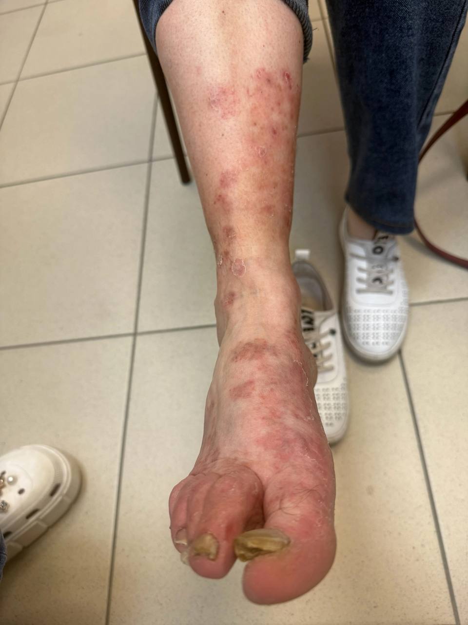 Девочки, тут ПИЗДЕЦ 

Стырила фотку у врача, пациентка пришла с жалобой на экзему. Ходила к дерматологу,...
